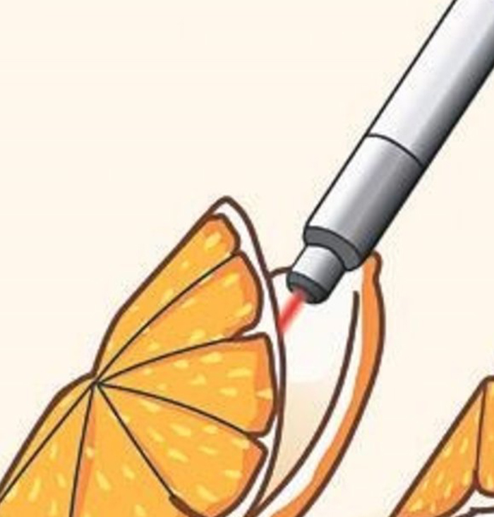 HoLEP Nedir? HoLEP ile Prostat Ameliyatı Nasıl Yapılır?